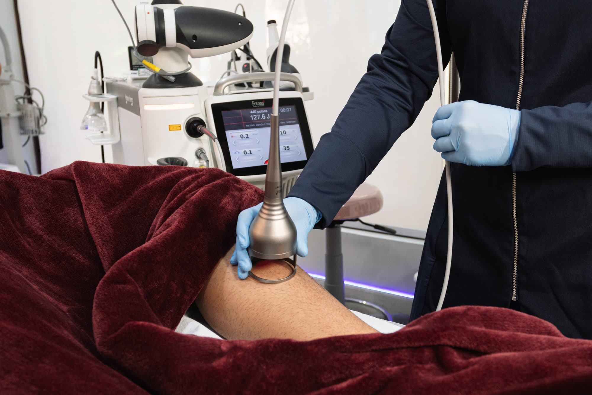 Aplicação de laser Fotona em coxa do paciente com aplicador metálico segurado por mão de luva azul; equipamento Fotona Nd:YAG + Er:YAG ao fundo com display digital de parâmetros de fotobiomodulação.